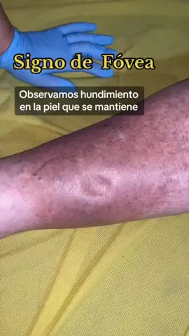 Signo de fóvea para valorar si el paciente acumula líquidos. #fisioterapia, #fóvea, #piernas, #acumulacióndelíquido #piernashinchadas #retornovenoso 