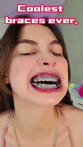 Super cool mechanical braces
