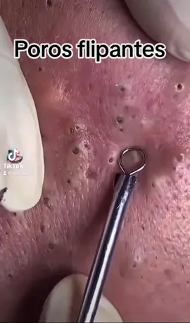 exttracion satisfactoria #extractions #puntosnegros #acne #grasa #espinillas #granos #poros #facial 