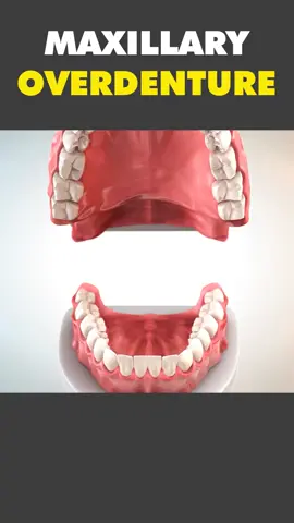 Maxillary Overddnture 3D Animation #maxillaryoverdenture #overdenture #overdentures #denture #dentures #denturejourney #overdenturefitting #artificialtooth #faketooth #dentalprocedure #3dmedicalanimation #medical3danimation 