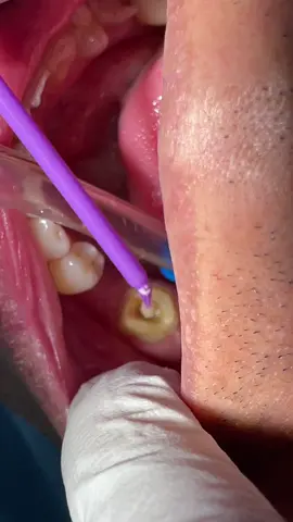 Ada beberapa jenis Crown yang ada di Klinik kami . Salah satunya adalah “ENDO CROWN” yang dilakukan keatas patient .  Crown gigi adalah prosedur pemasangan sarung gigi. Kelebihan crown adalah dapat mengembalikan bentuk gigi, ukuran, kekuatan dan mengembalikan penampilan gigi yang lebih efisien 😁  Nak senyum nampak gigi dengan cantik ? Jangan tunggu lama. JOM buat temu janji korang dengan doktor syamil sekarang !! 😁 #Crown #Doktorgigi  #Klinikgigidrsyamil #Klinikgigi #Klinikgigiwangsamaju #Dentalclinic #Dentalclinicwangsamaju 