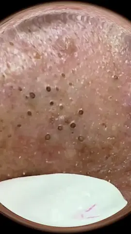 Mụn đầu đen #ghiennanmuntiktok #ghiennanmunn #ghiennanmunne #squeezeacne #squeezer #squeezepimples #squeezeblackrad #acneskin #blackacne #blackacneremover #removeacne #acneskincare #blacknose #nanmunsieuphe #acnetreatment #relax  #relaxingvideos #relaxingpimple #relaxsqueeze #祛痘 #黑头粉刺 #tiktoknews #tiktokviral #tiktok #trendingvideo #trendy #xuhuongtiktok #xuhuong2023 #xuhuongtiktok2023 #xuhuongtiktokk #xuhuong #reward #rewards #tiktokusa🇺🇸 #tiktokusa #tiktokus #trendingvideo #trendy #tiktokcanada 