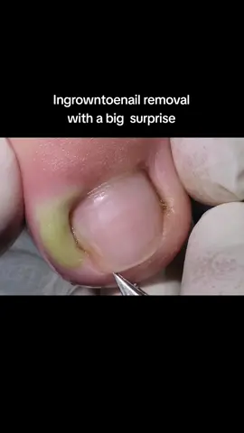 #fyp #fypシ #fy #fungalnail #fungalinfection #fungus #ingrowntoenailremoval #ingrowntoenail #podiatrist #podiatry #pedicurist #nailcleaning #nail #manicure #pedicure #feetcare #toenailremoval #toenail #medical 