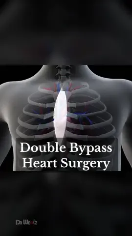 Double Bypass Heart Surgery #heart #surgery #health 