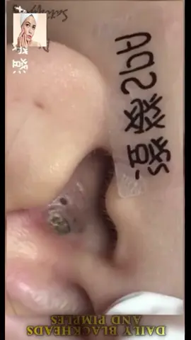 #squeeze #squeezeyuk #acne #pimple #pimplepop #blackhead #satisfying #foryoupage 217
