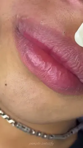 Amazing 😍 #pimple #pimplepop #tiktoklongs #pimplepopperaddict #relaxing #pourtoi #satisfying #foryou #explore 
