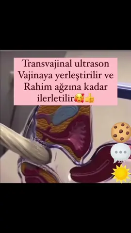 transvajinal ultrason 