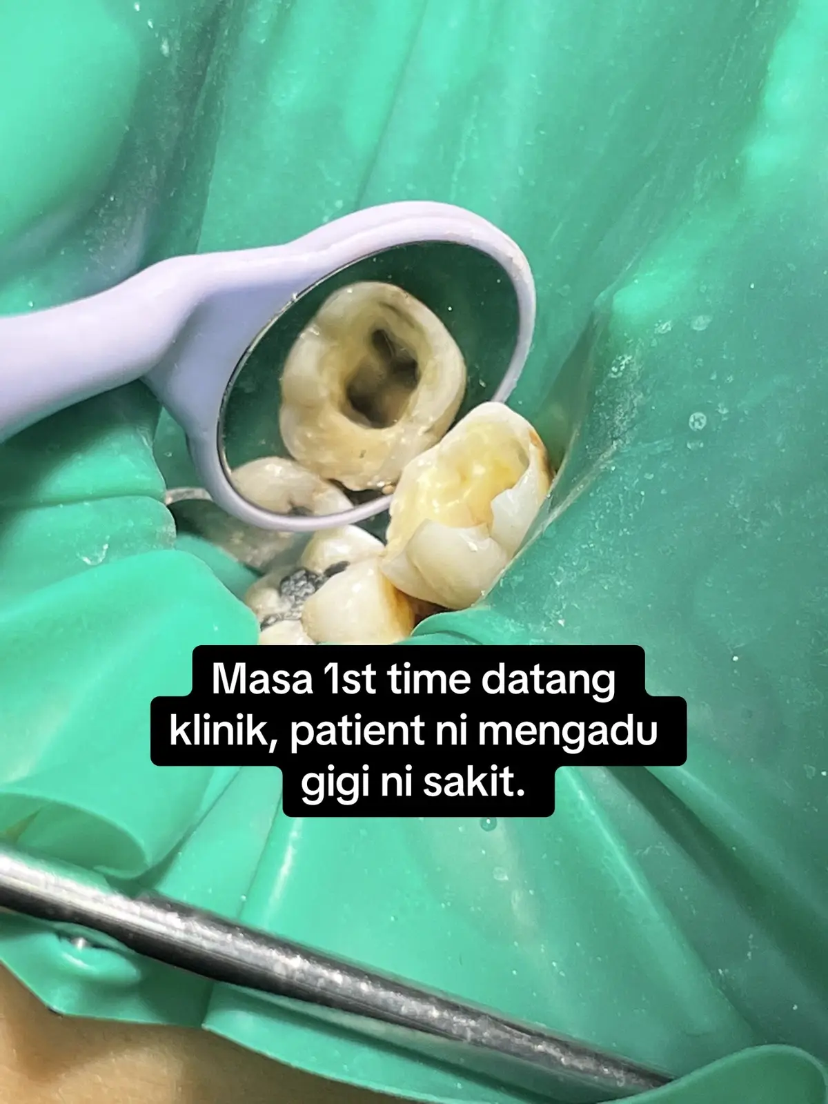 #dentistpasirgudang #doktorgigipasirgudang #dentalclinicpasirgudang #klinikgigipasirgudang #fypシ゚viral #shouldbeme #fyp #fypage #pasirgudang #jbstyle #jbstyle🔥 #pasirgudangproblem #rootcanal #rootcanaltreatment #rawatanakar