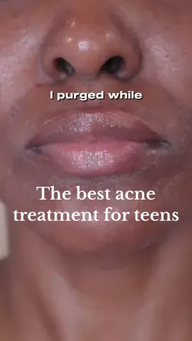 Replying to @Isabella Yes, I would definitely recommend Differin gel for teenage acne #teenacne #differingelpurging #teenageacnetreatments #teenageacnesolution #teenacnetreatment #teenskincaresolutions 
