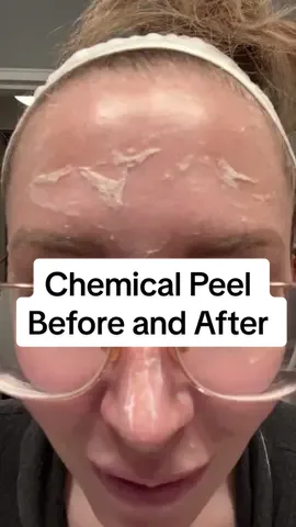 I haven’t done this in years but would definitely do it again, not a fan of the downtime though #chemicalpeel #peels #skincare #skincaretips #beforeandafter #chemicalpeelbeforeandafter 