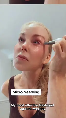 Microneedling os the best treatment against wrinkles. Usually after 1-2 sessions you will see results. #wrinkles #microneedling #skincare #sundamage #dermafyx  