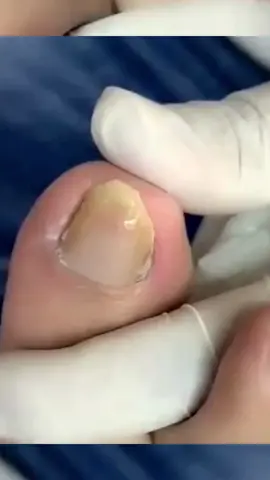 #toenails  #ingrowntoenail  #toenailremoval  #toenail  #toenail  #satisfying  #foryou