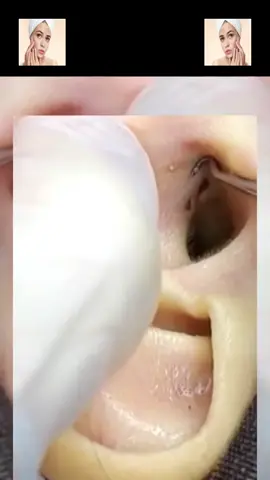 #squeeze #squeezeyuk #acne #pimple #pimplepop #blackhead #satisfying #foryoupage 167