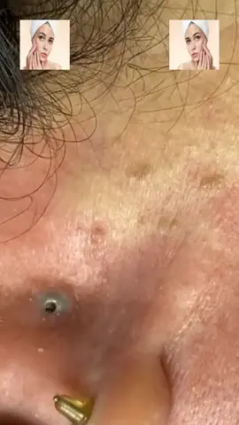 #squeeze #squeezeyuk #acne #pimple #pimplepop #blackhead #satisfying #foryoupage 217