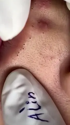 #pimplepop #foryou #blackhead #fy #satysfying 