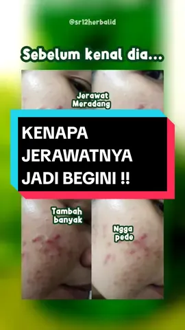 Jerawatnya jadi pada kemana ini bestie ? 🥹 #jerawat #pejuangjerawat #wajahjerawat #solusijerawat #sabunjerawat #jerawatnanah #facialwashgreenteasr12 #sr12halal #sr12skincare #sr12bpom #sr12herbalid #sr12bekasi 