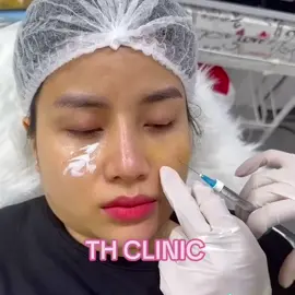 ⚠️TIÊM THÂM MẮT ĐÂY TRŨNG MẮT bằng dòng HA Vip TEOXANE REDENSITY 2⚠️  DỊCH VỤ TẠI TH CLINIC  💉 𝐋𝐚̀𝐦 đ𝐞̣𝐩 𝐤𝐡𝐨̂𝐧𝐠 𝐜𝐚𝐧 𝐭𝐡𝐢𝐞̣̂𝐩 𝐏𝐓 *  Filler Môi, má, thái dương, cằm, rãnh cười… * Làm đầy và xoá thâm trũng mắt.  *  Xoá nhăn tất cả các vùng: mắt, trán, cau mày, khoé miệng.  *  Thon gọn các vùng: hàm, bắp tay, bắp chân, bả vai.  * Tan mỡ các vùng: bụng, eo, lưng, mặt, nọng, tay, đùi. *Triệt mồ hôi nách, bàn tay và bàn chân *Cấy Chỉ COLLAGEN: trẻ hoá da và thâm mắt  💉 𝘿𝙞̣𝙘𝙝 𝙫𝙪̣ 𝙈𝙚𝙨𝙤𝙩𝙝𝙚𝙧𝙖𝙥𝙮:  * Meso thường (Sáng da, cấp ẩm) * Meso Exosome (Căng bóng, sáng da, cấp ẩm, chống lão hoá) * Meso Eye (giảm thâm mắt) * Meso điều trị nám, tàn nhang  * PROFHILO / JALUPRO B.A.P (Tái sinh đa tầng) ——————————————— TH CLINIC Add: Phú nhuận 𝘽𝙤𝙤𝙠𝙞𝙣𝙜   :𝙸𝚗𝚋𝚘𝚡 | 𝙲𝚊𝚕𝚕 077 7757389 #Spa #Filler #lipfiller #botox #fillemoi #fillermábaby #fillercằm #fillertrán #Điềutrịda #điềutrịdacôngnghệcao #tiêmmeso #mesotherapy #Nângcơ #xoánhăn #Profhilo #Skintreatment #Beauty #Xoá_Nhăn_Nâng_Cơ #BAP #Filler_Botox_mùi_cơ_thể