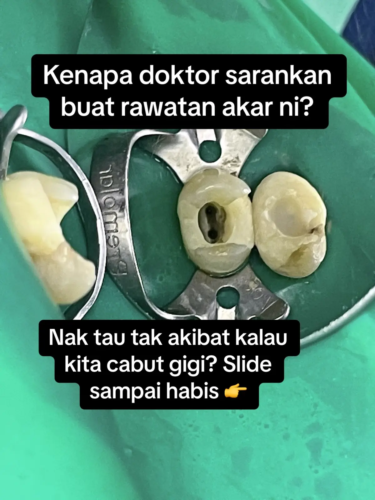 #dentistpasirgudang #doktorgigipasirgudang #dentalclinicpasirgudang #klinikgigipasirgudang #fypシ゚viral #shouldbeme #fyp #fypage #pasirgudang #jbstyle #jbstyle🔥 #pasirgudangproblem #rootcanal #rootcanaltreatment #rawatanakar #rawatanakarpasirgudang 