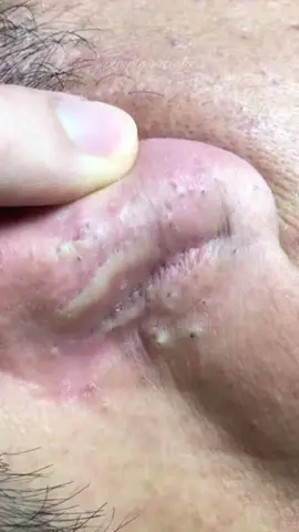 Hello Hello ❤️❤️❤️#ConSantanderConecto#tiktoklongs #viralvideo #foryou #pimple #fyp #explore #satisfying #acne 