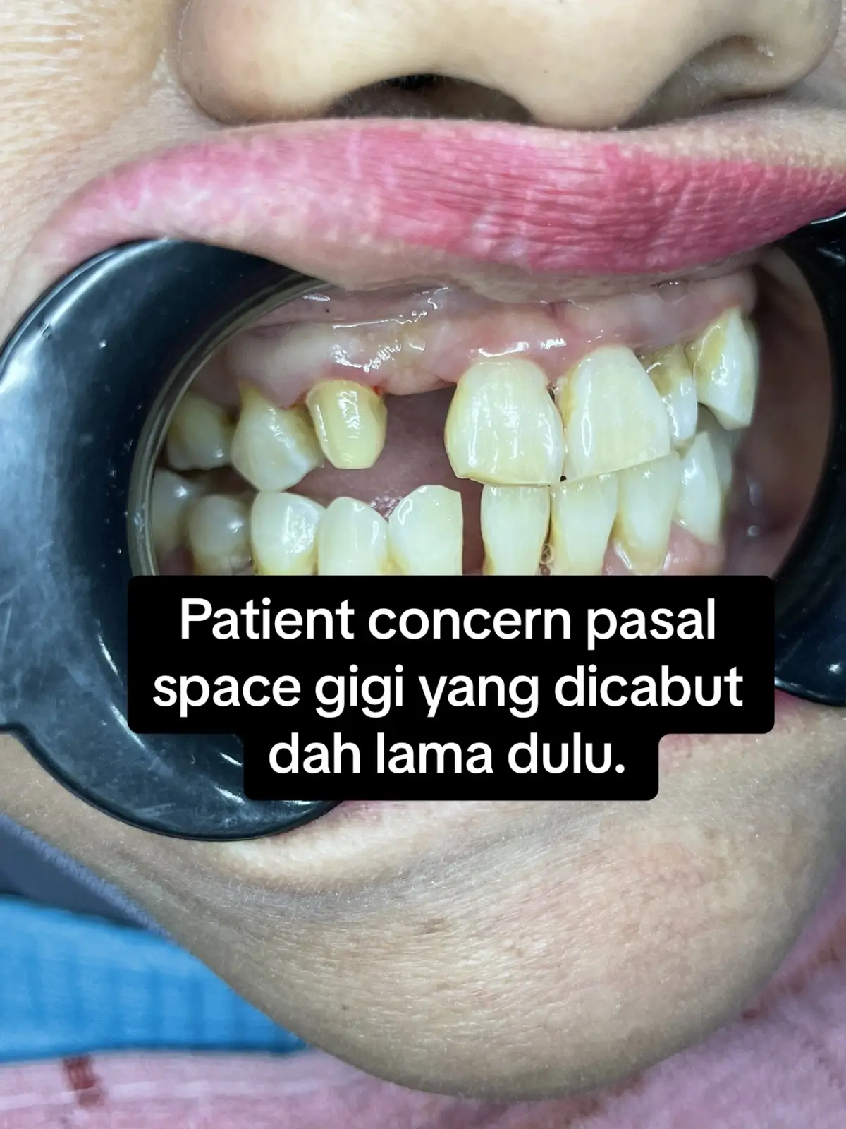 #dentistpasirgudang #doktorgigipasirgudang #dentalclinicpasirgudang #klinikgigipasirgudang #fypシ゚viral #shouldbeme #fyp #fypage #pasirgudang #jbstyle #jbstyle🔥 #pasirgudangproblem #dentalbridge #dentalbridges #jambatangigicantilever #