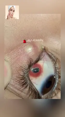 #squeeze #squeezeyuk #acne #pimple #pimplepop #blackhead #satisfying #foryoupage 1717