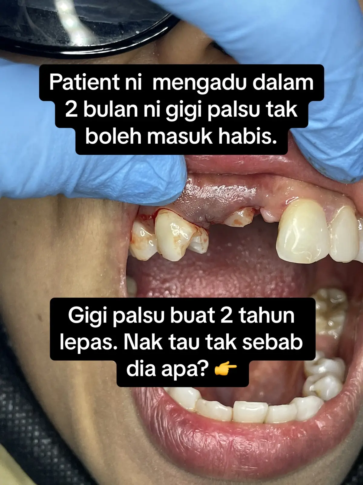 #dentistpasirgudang #doktorgigipasirgudang #dentalclinicpasirgudang #klinikgigipasirgudang #fypシ゚viral #shouldbeme #fyp #fypage #pasirgudang #jbstyle #jbstyle🔥 #pasirgudangproblem #impacted #impactedtooth #impactedtoothremoval #impactedcanine #impactedcaninesurgery #gigiterimpak #gigitersekat 