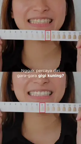 Sudah bukan waktunya lagi untuk insecure masalah gigi 🤓