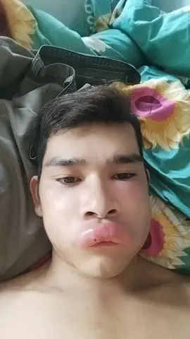 bị chị ong hôm vào môi