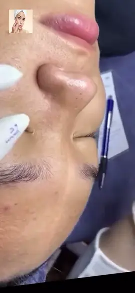 #squeeze #squeezeyuk #acne #pimple #pimplepop #blackhead #satisfying #foryoupage 105
