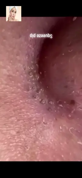 #squeeze #squeezeyuk #acne #pimple #pimplepop #blackhead #satisfying #foryoupage 149