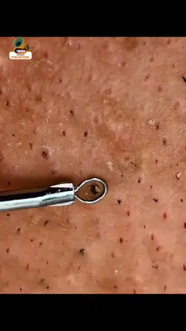 #satisfyingvideo #waxingvideos #ingrownhair #satisfyingremoval #extractions #fyp #tweezers 