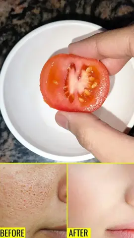 🔥 Open pores home remedy #bbbeauty46 #foryou #skincare 