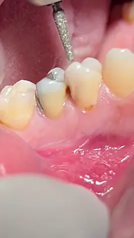 Tooth deep caries , started root canal treatment #dentist #dentista #dental #tooth #caries #rootcanaltreatment 