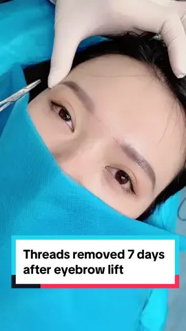 Threads removed 7 days after eyebrow lift#xuhuowngtiktok #dubai🇦🇪 #dubai🇦🇪 #pttm 