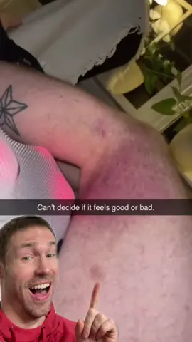 This bruise looks like it hurts #stitch with @Rasmus #ouch #injury #pain #health #anatomy #LearnOnTikTok #learnwithtiktok 