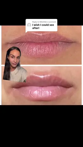Replying to @MA235L #greenscreen #results #liplaser #plumplips #naturalcollagen #lasertreatmen #naturallips #fotona 