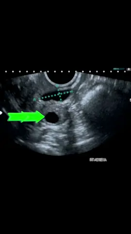 #ultrasoundguidedfillerdissolution #ultrasound #uti #ovary cyst#tiktokviraltrending #medicosdetiktok #medstudentlife #ultrasound #cystitis 