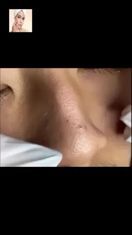 #squeeze #squeezeyuk #acne #pimple #pimplepop #blackhead #satisfying #foryoupage 17