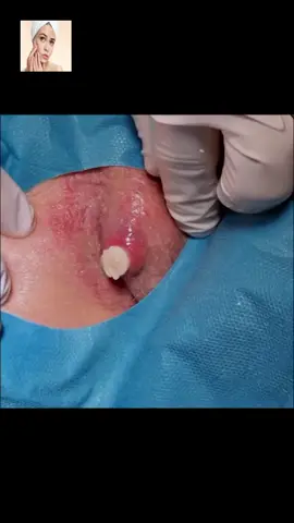 #squeeze #squeezeyuk #acne #pimple #pimplepop #blackhead #satisfying #foryoupage 105