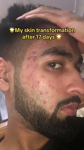 ❤️Explore my incredible skin journey from dealing with acne and damaged skin to achieving a remarkable transformation in under one month!❤️ #fyp #foryou #trending #viral #skin #skincare #acne #clearingacne #hyperpigmentation #skin #faceserum #collagen #serum #men #girls #boys