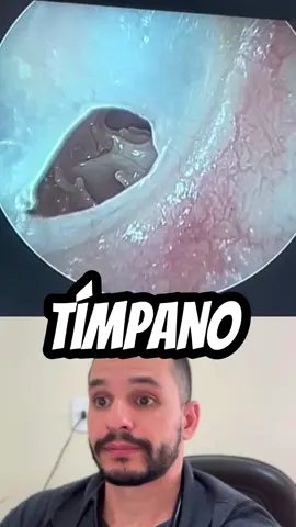 O tímpano é uma membrana fina e semitransparente existente na profundidade do canal do ouvido com qualidades vibratórias especiais. Por ser muito sensível e fino, o tímpano pode ser perfurado facilmente! Com formato arredondado, ele vibra quando o som a atinge e transmite essa vibração para ossículos do ouvido médio, que por sua vez, o levam até a cóclea - que fica no ouvido interno.  Se houver a perfuração do tímpano, as ondas sonoras não são transmitidas, os ossículos não se movimentam e a vibração sonora não chega até a cóclea. Dessa maneira a audição fica prejudicada.  Como atuam em conjunto, todas as estruturas presentes no ouvido precisam funcionar da maneira correta para que o som seja levado do ambiente para a cóclea, e então levado pelo nervo auditivo até o cérebro Evite soluções caseiras - muito encontradas em pesquisas na internet - e procure a ajuda de um otorrinolaringologista.