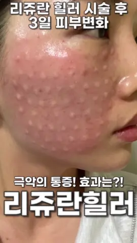 피부 좋아지는 방법이요? #피부재생 #피부관리 #여드름 #좁쌀여드름 #남자화장 #여자화장 #겨울코디 #mbti #쿨톤 #웜톤 #enfp #꿀팁 출처 - youtube 나시리 nasiri