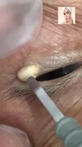 #squeeze #squeezeyuk #acne #pimple #pimplepop #blackhead #satisfying #foryoupage 62