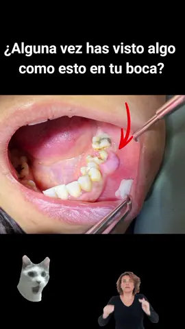 ¿Qué es un absceso dental? 🦷💉💊 #odontologia #abscesodental #infecciondental #dolordental #dentistapuebla #odontologopuebla #dentistry #dentist #dentistlife #abscesodental #infecciondental #dolordental #dentistapuebla #odontologopuebla #dentistry #dentist #dentistlife 