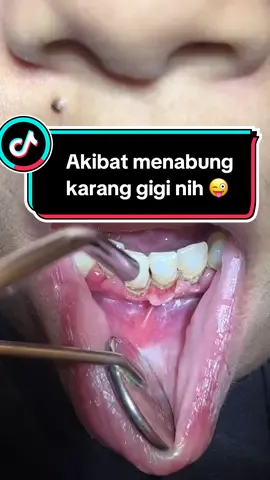 Akibat menabung karang gigi nih 😝😝#doktergigi #fyp #kesehatangigidanmulut #scalinggigi #behelgigi #tambalgigi #cabutgigibungsu 