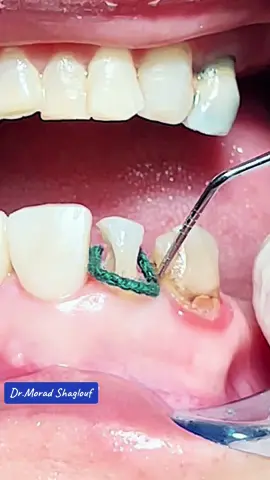 Fiber post & composite restoration for anterior teeth after root canal treatment #composite #restoration #teeth #fiber_post #rootcanal #rootcanaltreatment 