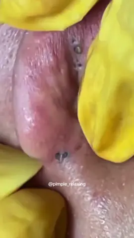 #blackhead #acne #pimplepop #extractionsatisfaciton #satisfactionvideo 