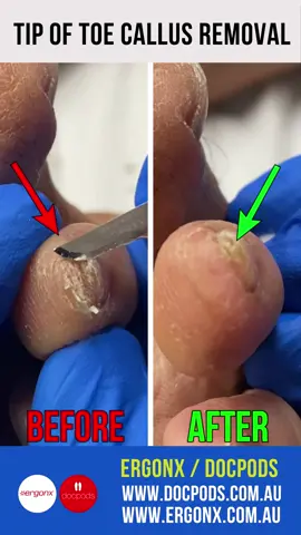 Tip of Toe Callus Cut Back by Podiatrist #satisfying #corn #callus #podiatrist #australia #ergonx #docpods