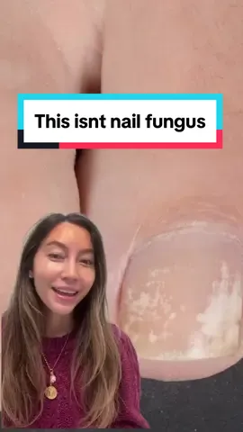 Do you have these white spots on your nails? Good news— its not fungus! #nails #nail #nailfungus #nailfungustreatment #nailfungusremedies #fyp #dermatology 