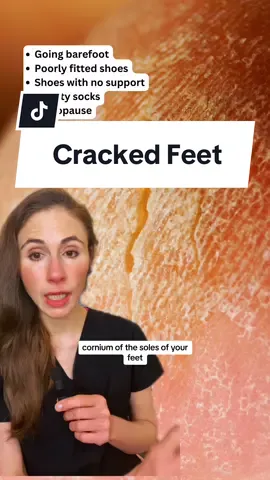 @Dr Dray | Dermatologist 5 Reasons You Have Dry Cracked Feet. Dermatologist Dr. Dray on 5 causes of cracked heels and rough callus on the feet. #crackedfeet #dryfeet #crackedheels #dermatologist 